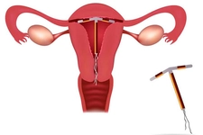 Spiral Yan Etkileri Nelerdir? Spiral Yan Etkileri Nelerdir?