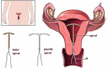 Gebelikten Korunma Spiral Kullanımı ve Faydaları Nelerdir? Gebelikten Korunma Spiral Kullanımı ve Faydaları Nelerdir?