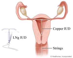 Spiral Doğum Kontrol Kullanımı ve Faydaları Nelerdir? Spiral Doğum Kontrol Kullanımı ve Faydaları Nelerdir?